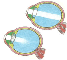 In alto l'occhio normale. In basso l'occhio malato di cataratta. Nel primo caso la luce entra regolarmente, nel secondo non riesce a passare.